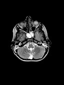 MRI of Otomastoiditis and Sphenoid Sinusitis