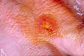 Tularemia Ulcer