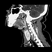 CT of neck showing thyroid nodule