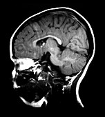MRI of Tuberous Sclerosis