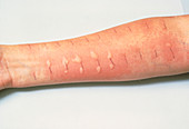 Allergy testing:patients arm showing skin reaction