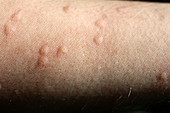 Rash from fire ant stings