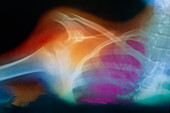 False-colour X-ray of a dislocated shoulder