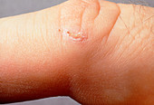 Close-up of a small cut healing on a finger