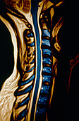 Coloured MRI of herniated discs in the neck