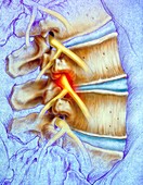 Compressed lumbar nerve