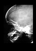 Lateral X-Ray of a Child With Head Trauma