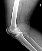 Lateral X-Ray of the Knee