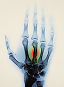 Fractured hand x-ray