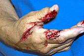 Hand Laceration