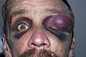 Bruises and ecchymoses around the eyes