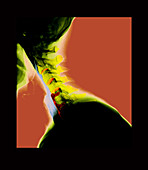 X-ray of Fracture and Fusion of Spine