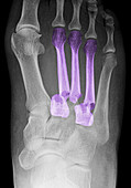 Foot Fractures