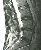 MRI