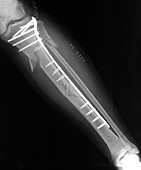 Fractured Tibia