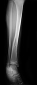 X-ray of Fractured Tibia