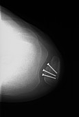 X-ray of Knee Bone Screws