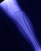 X-ray of Broken Leg