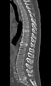 Elderly Thoracic and Lumbar Spine