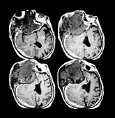 MRI Showing Head Trauma