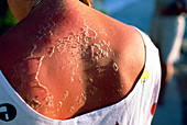 Peeling skin on back of sunburnt woman