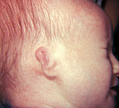 Neonatal Abnormality