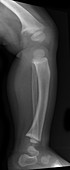 X-ray of Deformed Child Tibia