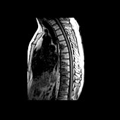 MRI of Metastatic Disease to Thoracic Spine