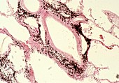 Light micrograph of a smoker's lung