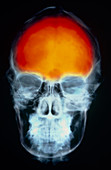 Coloured X-ray of the skull,representing headache