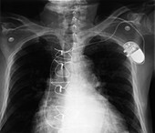X-ray of Implanted Defibrillator