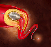Illustration of an angioplasty system