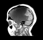 MRI shows near total hemispherectomy