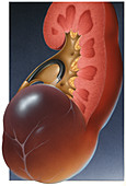 Renal Cyst