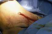 Abdominoplasty