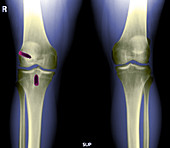 ACL Repair