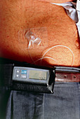 Insulin pump attached to man's abdomen