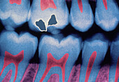 Coloured X-ray showing fillings in a molar tooth