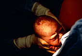 Head of baby emerging during childbirth