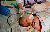 Nurse attending baby in paediatric intensive care
