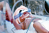 Premature infant in NICU