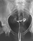 X-ray of Ovaries