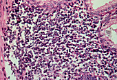LM of adenocarcinoma of the human prostate gland