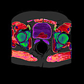 CT Cross Section of Enlarged Prostate