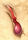 Spermatic Cord twisting