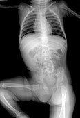 Frontal X-Ray of an Infant