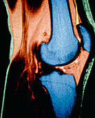 Coloured MRI of a human knee joint