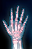 Hand,X-ray