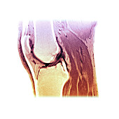 MRI of a normal knee
