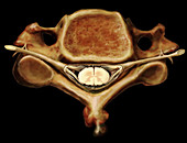 Cervical Vertebra